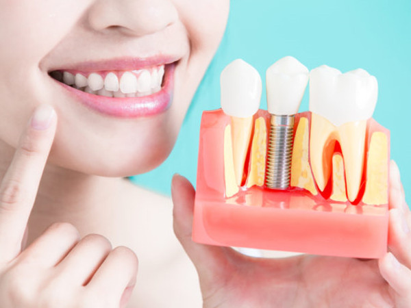 Five misunderstandings of dental implant cognition